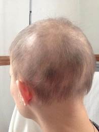 How do I know if I need an alopecia wig?