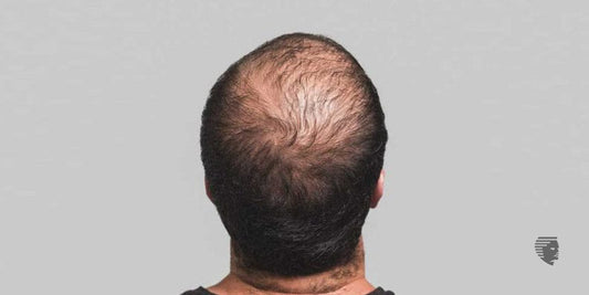 Wigs for Hair Loss